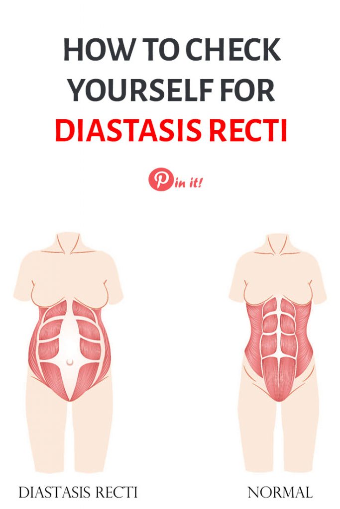 How to check yourself for diastasis recti. A guide through postpartum exercises that heal diastasis recti and rebuild core muscles. Postpartum weight loss tips for moms. #pregnancytips #breastfeedingweighloss