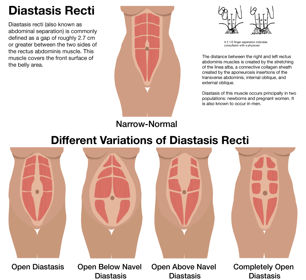 What is diastasis recti